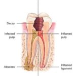 tooth root canal