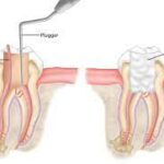 Root Canal Treatment in Lahore