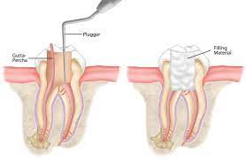 Root Canal Treatment in Lahore