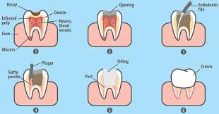 Root Canal Treatment in Lahore