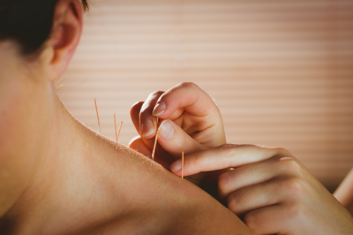 Acupuncture For Neck Pain In Morristown