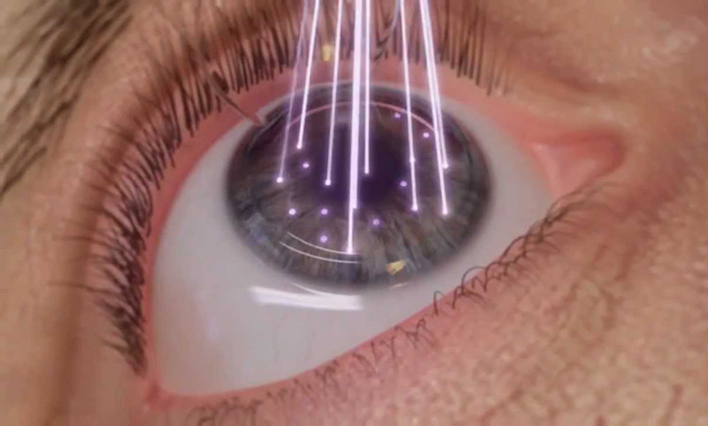 LASIK surgery