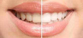 Teeth Whitening